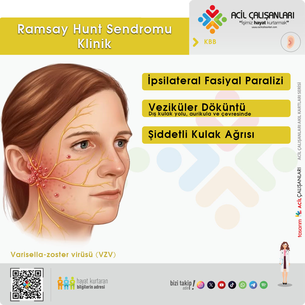 Ramsay Hunt Sendromu Klinik