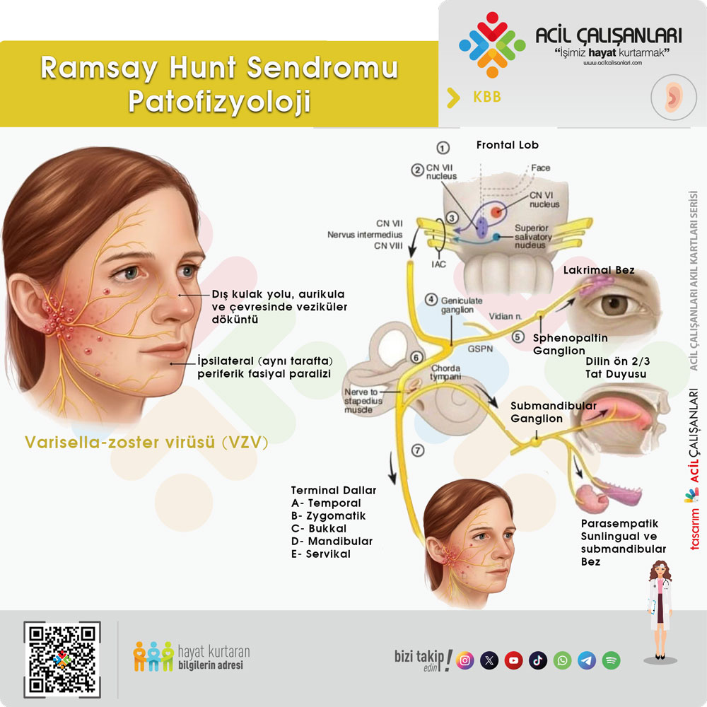 Ramsay Hunt Sendromu Patofizyoloji