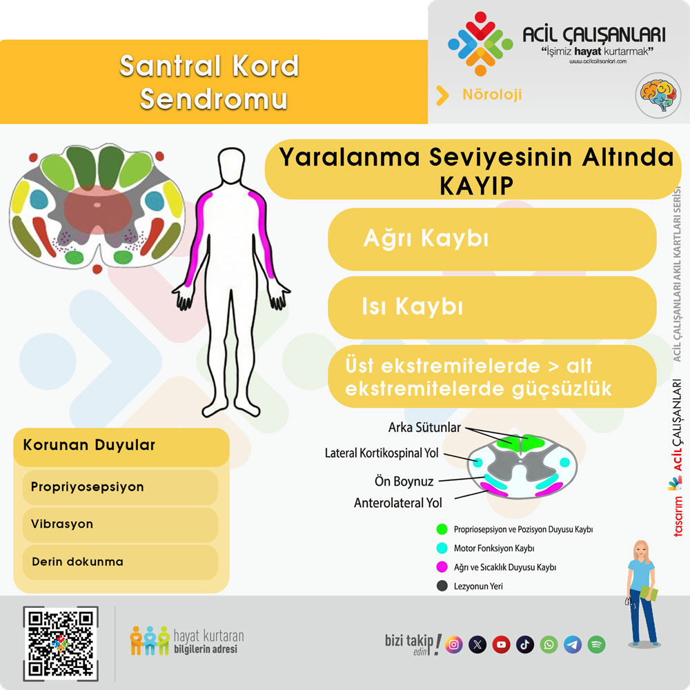 Santral Kord Sendromu