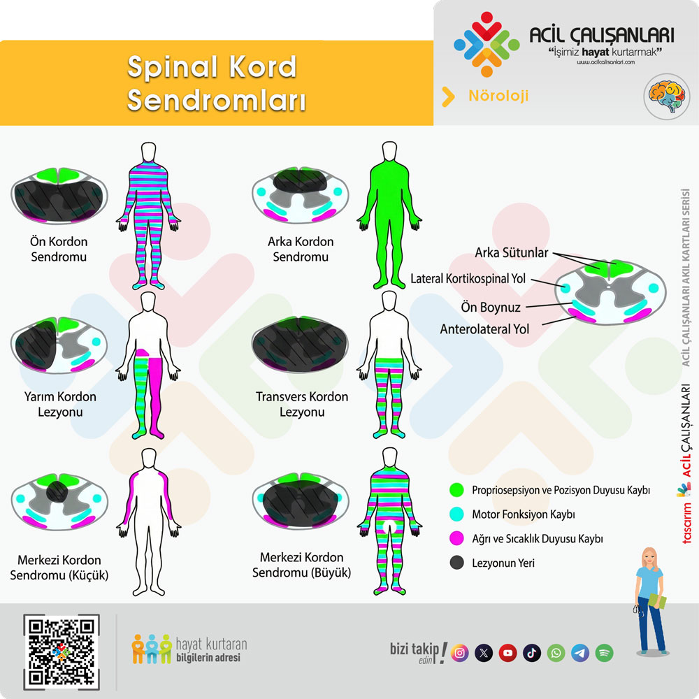 Spinal Kord Sendromları