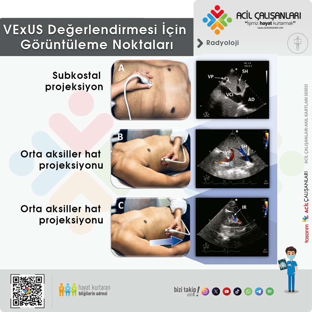 VExUS Değerlendirmesi 1