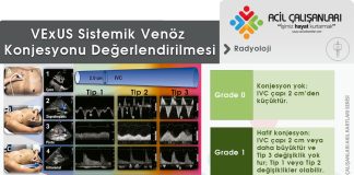 Venöz Yüklenme Ultrason Skoru (VExUS)