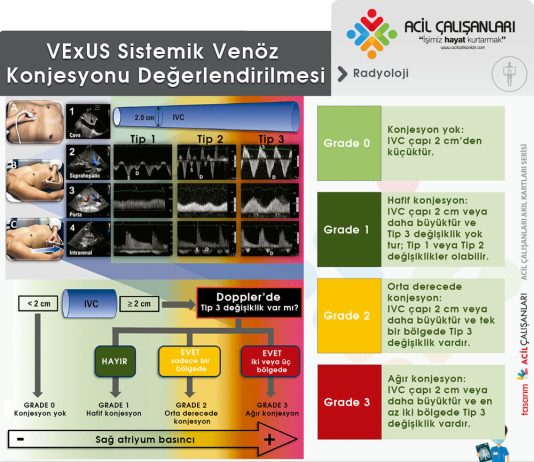 Venöz Yüklenme Ultrason Skoru (VExUS)