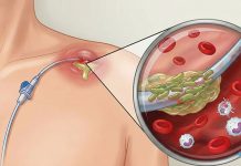 Santral Venöz Kateter ile İlişkili Enfeksiyonlar