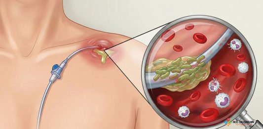 Santral Venöz Kateter ile İlişkili Enfeksiyonlar