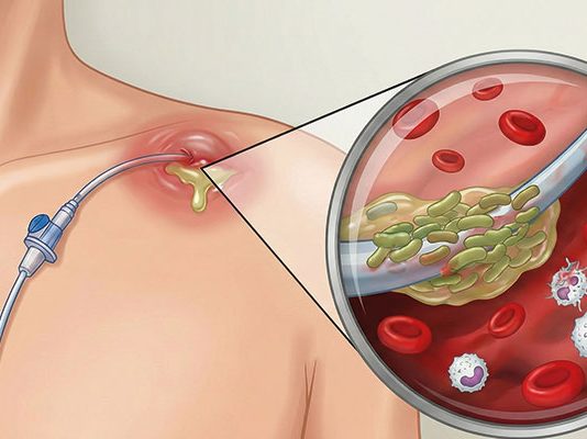 Santral Venöz Kateter ile İlişkili Enfeksiyonlar