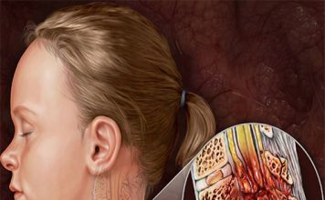 Spinal Kord Yaralanmaları