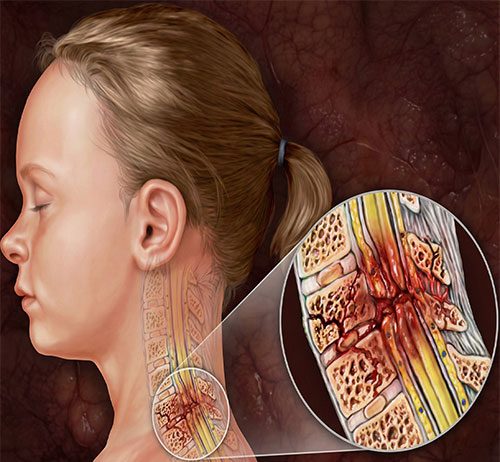 Spinal Kord Yaralanmaları