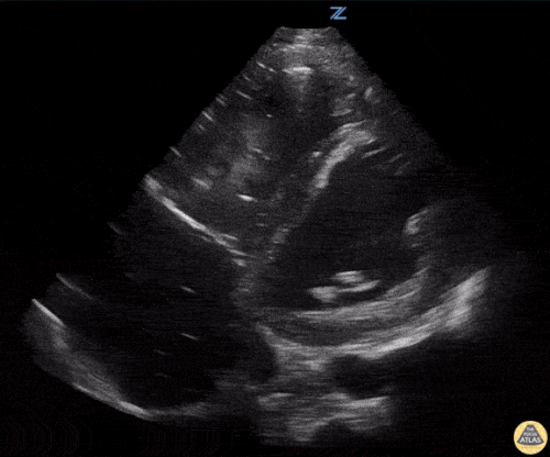 Biventriküler Yetmezlik