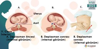 Aortokaval Kompresyon Sendromu