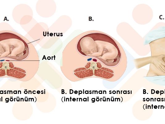Aortokaval Kompresyon Sendromu
