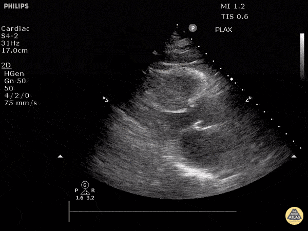 Hiperdinamik Durum (Uzun Aks)
