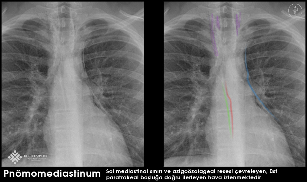 Pnömomediasten akciğer grafisi örneği