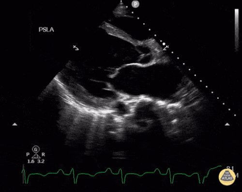 Postpartum Kardiyomiyopati