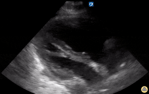 Sağ Ventrikül Yetmezliği