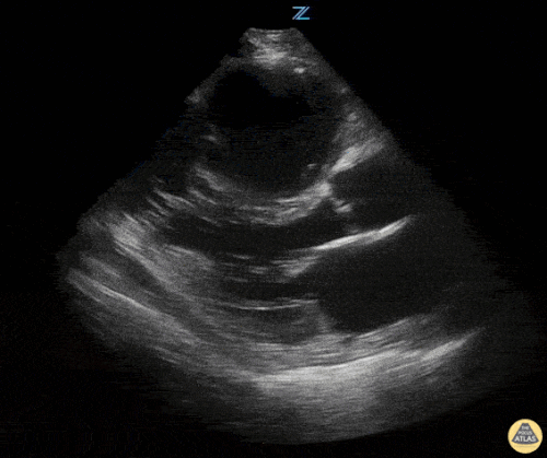 Sağ Ventrikül Yetmezliği 2