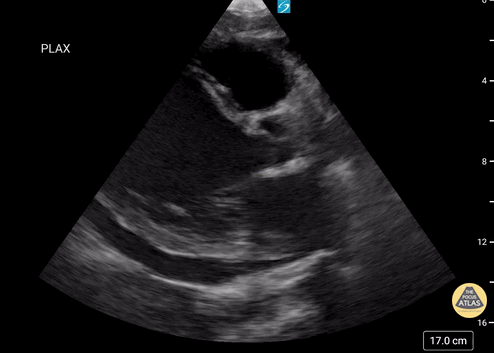 Yeni Başlangıçlı Kardiyomiyopati