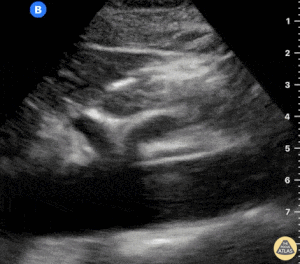 Normal Çölyak Trunkus ve SMA – Longitudinal