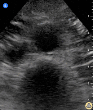 Normal Aort ve İliak Arterler – Transvers