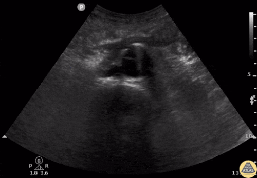 Diseksiyon flebi ile sakküler abdominal aort anevrizması