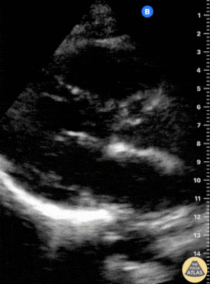 Normal PLAX Alternatif