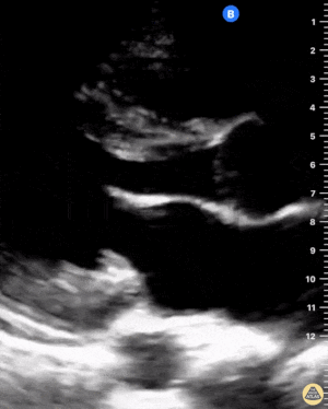 Normal Parasternal Long