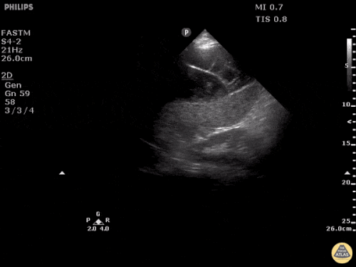 Subkapsüler Splenik Hematom