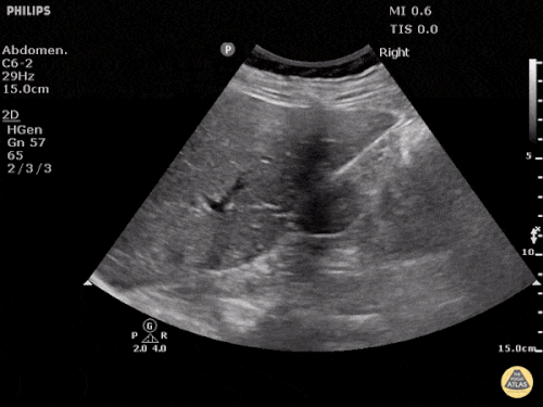 Normal FAST – Sağ Üst Kadran (RUQ)