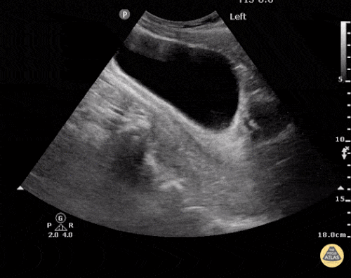Normal FAST – Pelvis – Sagittal