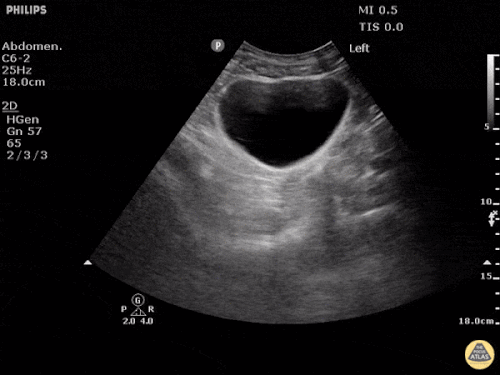 Normal FAST – Pelvis – Transvers