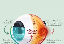 Glokom Acil Yaklaşım