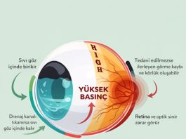 Glokom Acil Yaklaşım