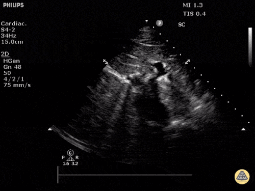 Normal İnferior Vena Cava