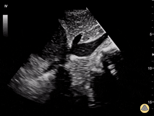 Kardiyak Tamponadda VCI’nin Görünümü