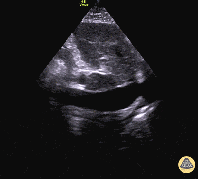 Biventriküler Yetmezlikte Pletorik VCI