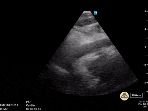 Tamponad ile birlikte sirkumferansiyel perikardiyal efüzyon