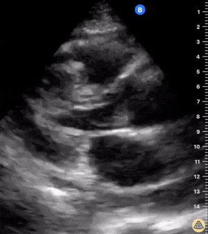 Tamponad ile birlikte sirkumferansiyel perikardiyal efüzyon 2