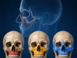 Le Fort Kırık Sınıflaması