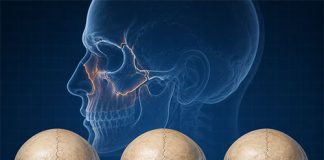 Le Fort Kırık Sınıflaması