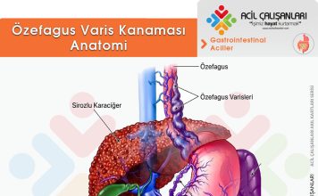 Özefagus Varis Kanaması
