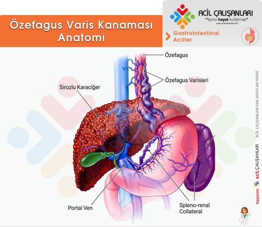 Özefagus Varis Kanaması
