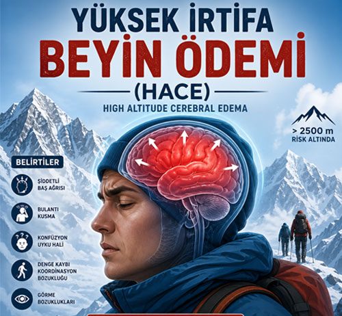 Yüksek İrtifa Beyin Ödemi (HACE)