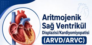 Aritmojenik Sağ Ventrikül Displazisi/Kardiyomiyopatisi (ARVD/ARVC)