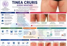 Tinea Cruris (Kasık Mantarı)