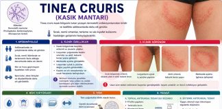 Tinea Cruris (Kasık Mantarı)