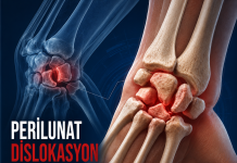 Perilunat Dislokasyon