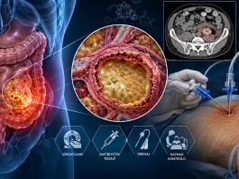 İntraabdominal Apse Acil Yaklaşım