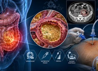 İntraabdominal Apse Acil Yaklaşım