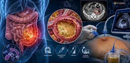 İntraabdominal Apse Acil Yaklaşım