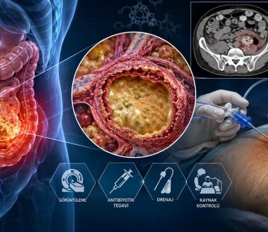 İntraabdominal Apse Acil Yaklaşım